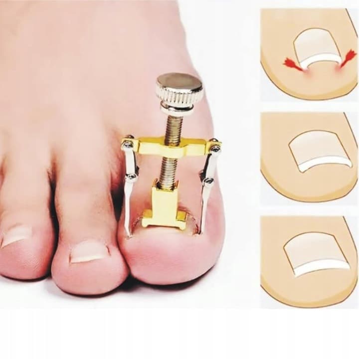 A2_tds0106_Klamra na wrastające paznokcie